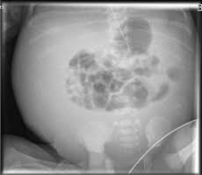 <p>Fluid collects within abdominal spaces- between the 2 layers of peritoneum</p><p>Cause infection</p>