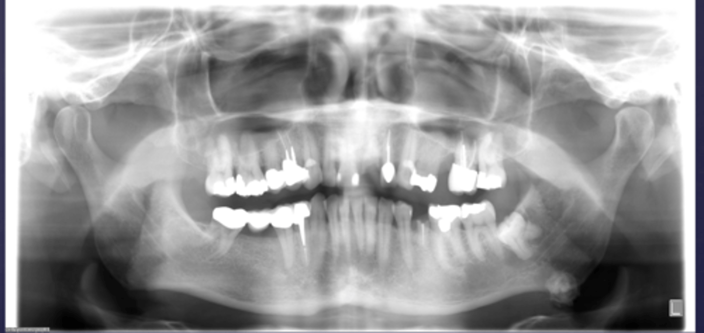 <p>What would be a differential diagnosis for this lesion?</p>
