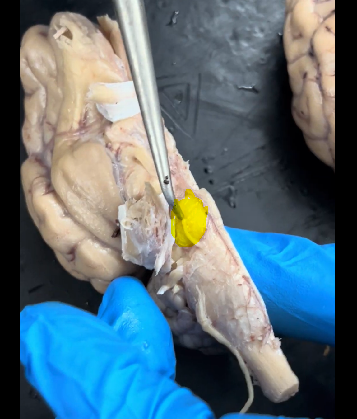 <p>Name the part of the brain that is highlighted in yellow.</p>