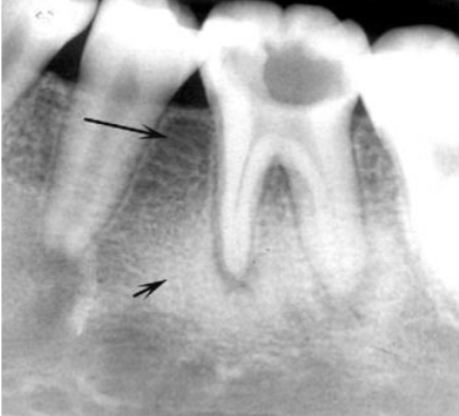 <p>describe the periphery of the lesion </p>