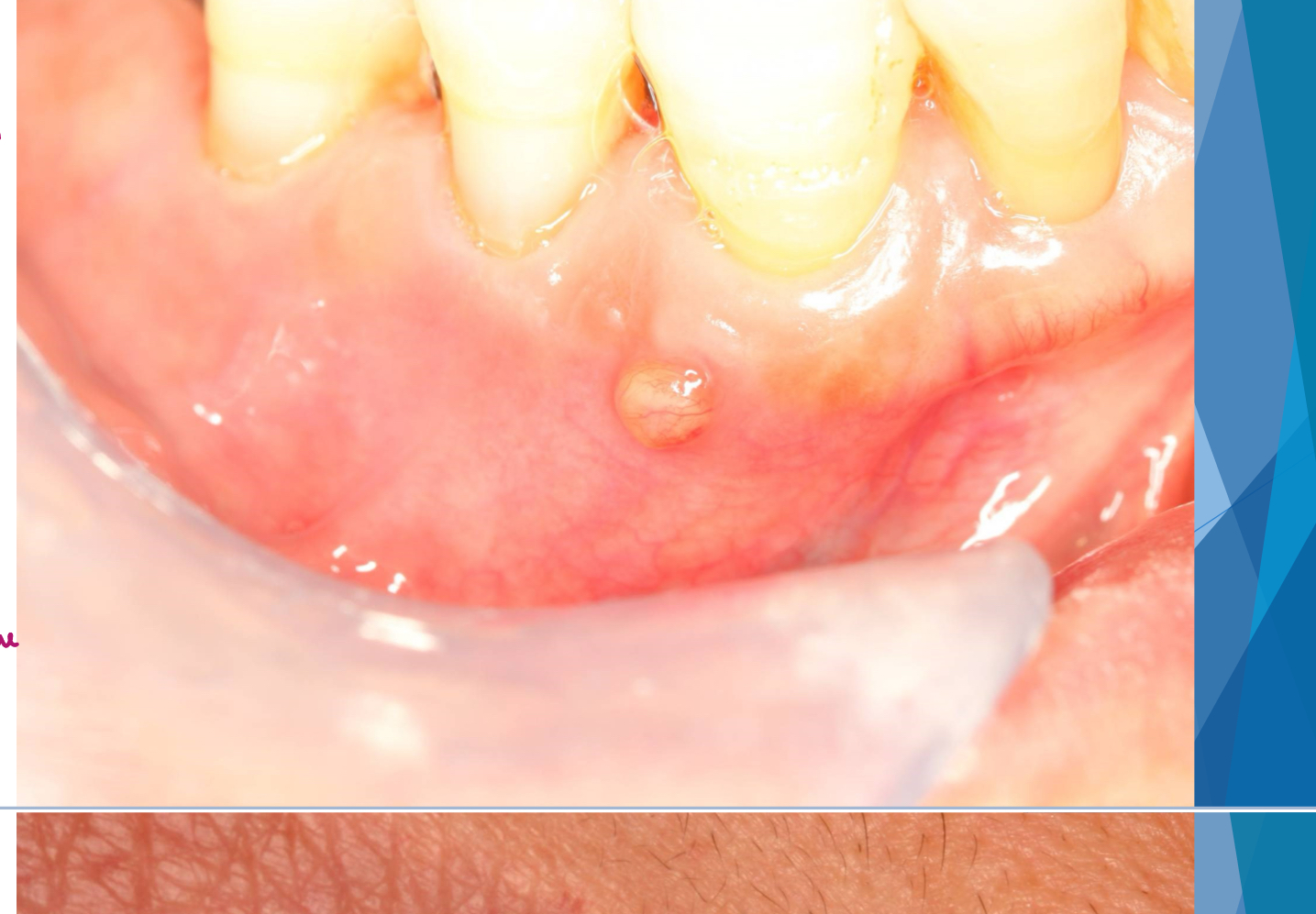 <p>which potential result of periapical inflammation?</p>