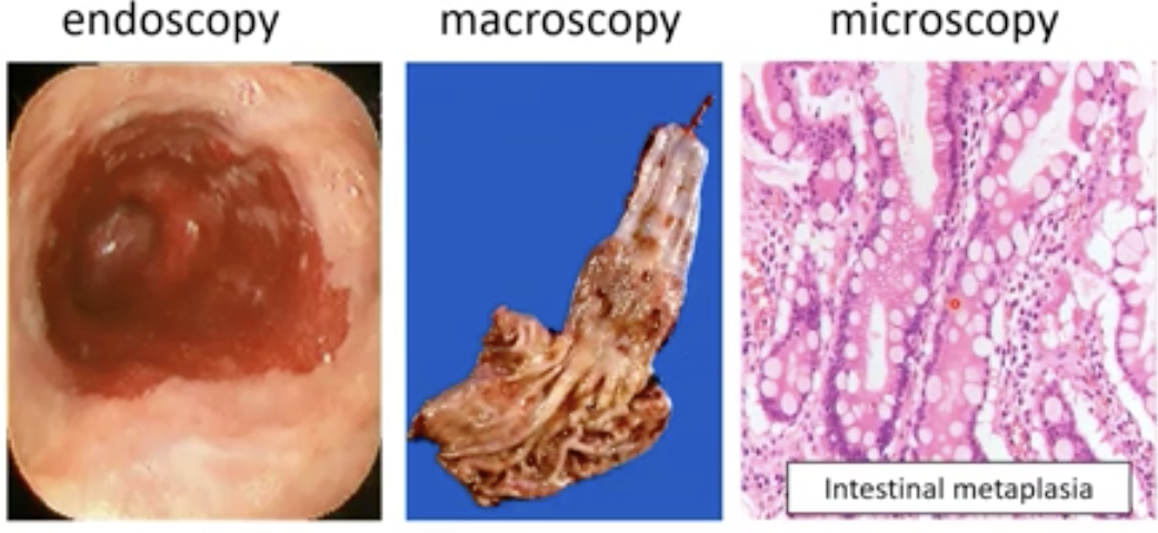 Phase 1: Inflammation due to content of stomach goes up to throat (too acidic) (Reflux oesophagitis) → hyperaemia, granulocytes and in severe cases ulceration 

 Phase 2: Metaplasia (intestinal) and CHRONIC inflammation (replacing normal squamous epithelia with intestinal type epithelium) aka Barett esophagus