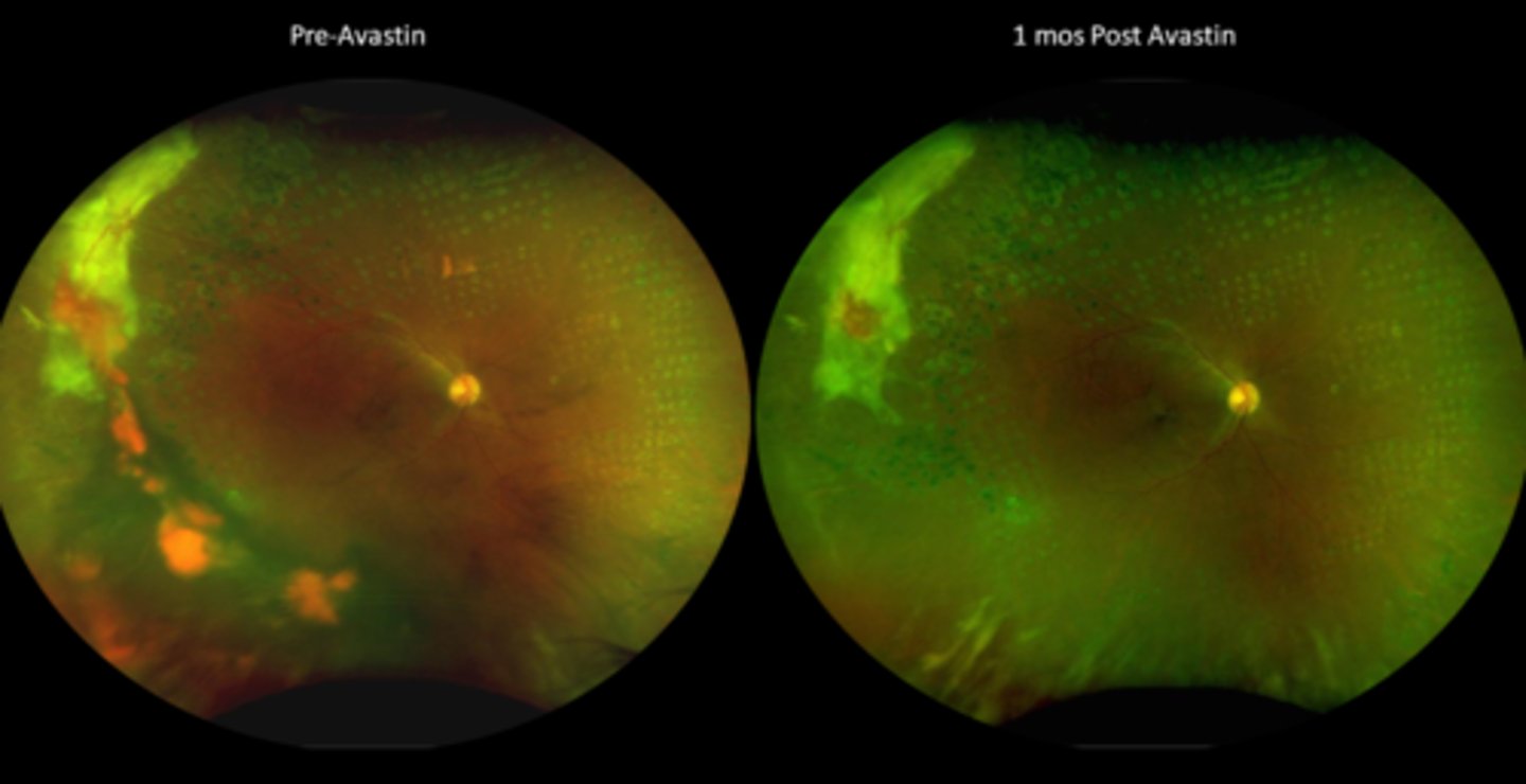 <p>What is the referral and f/u timeline for treating proliferative retinopathies with anti-VEGF?</p>