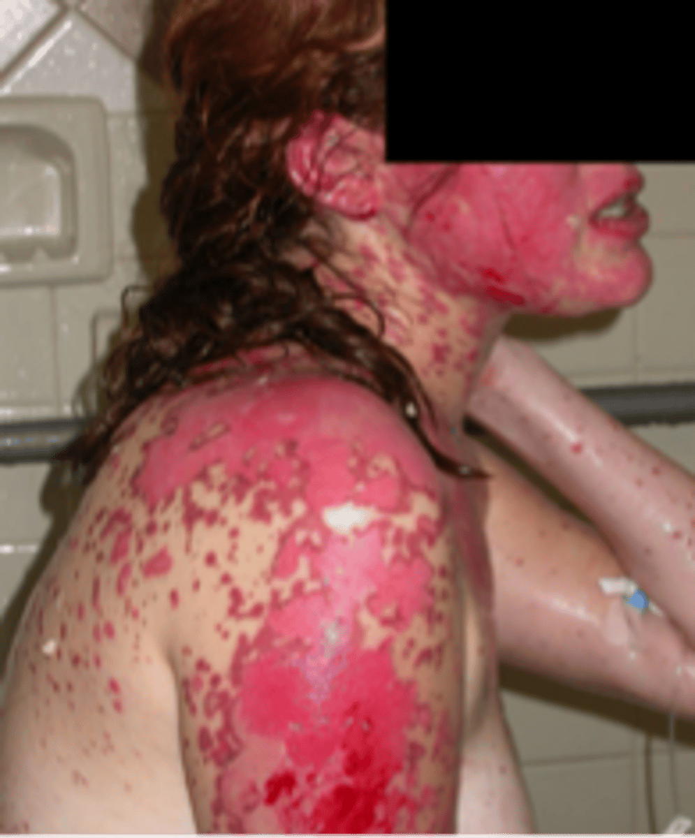 <p>This patient comes to the ER with a painful, expanding, and "sloughing" rash. They were recently treated for a UTI with sulfamethoxazole and trimethoprim. What is the likely Dx?</p>