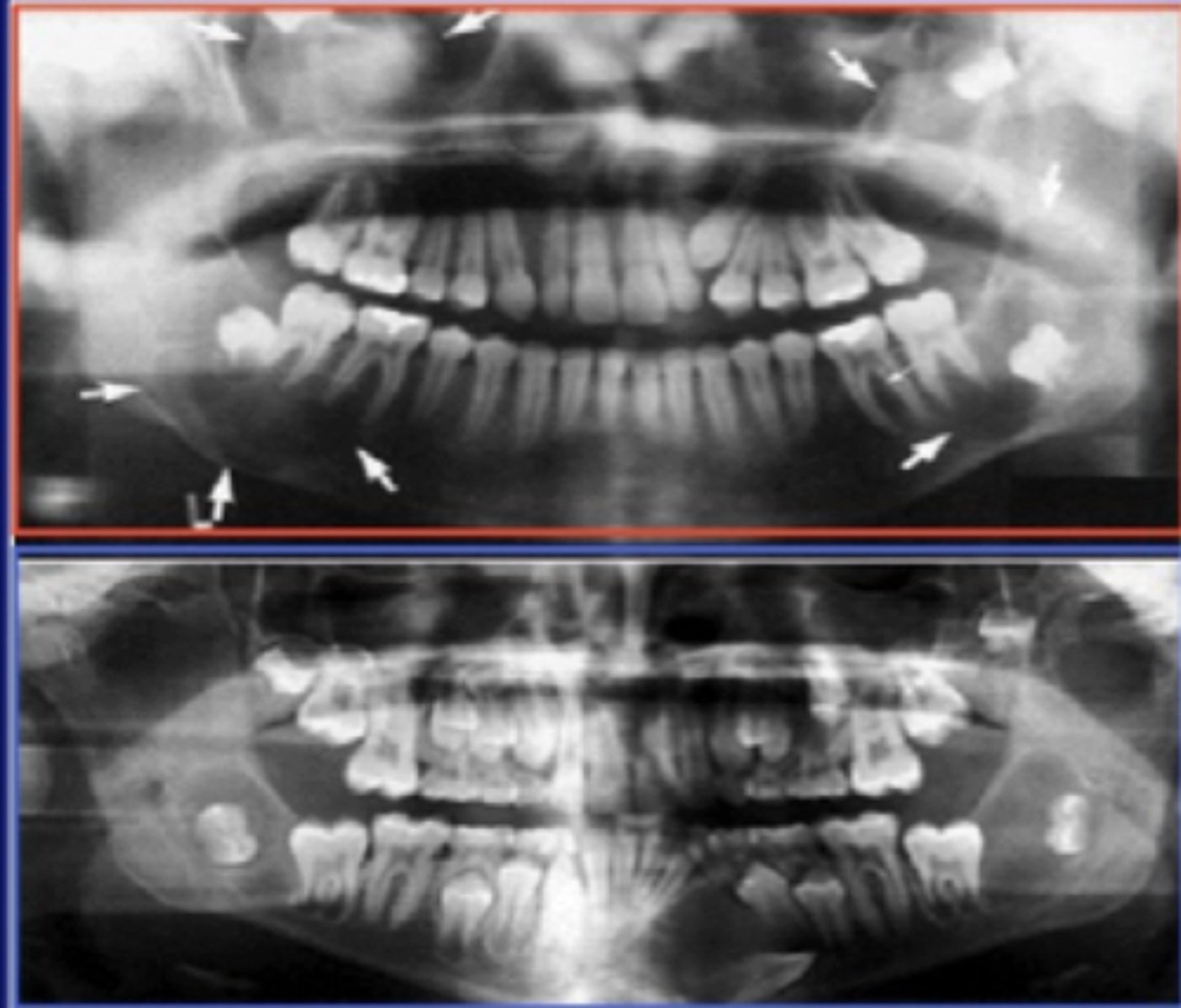 <p>multiple cysts of the jaws; odontogenic keratocysts (OKCs)</p>