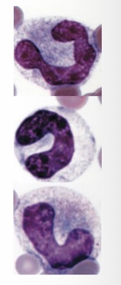 <p>Toxic changes to neutrophils </p>