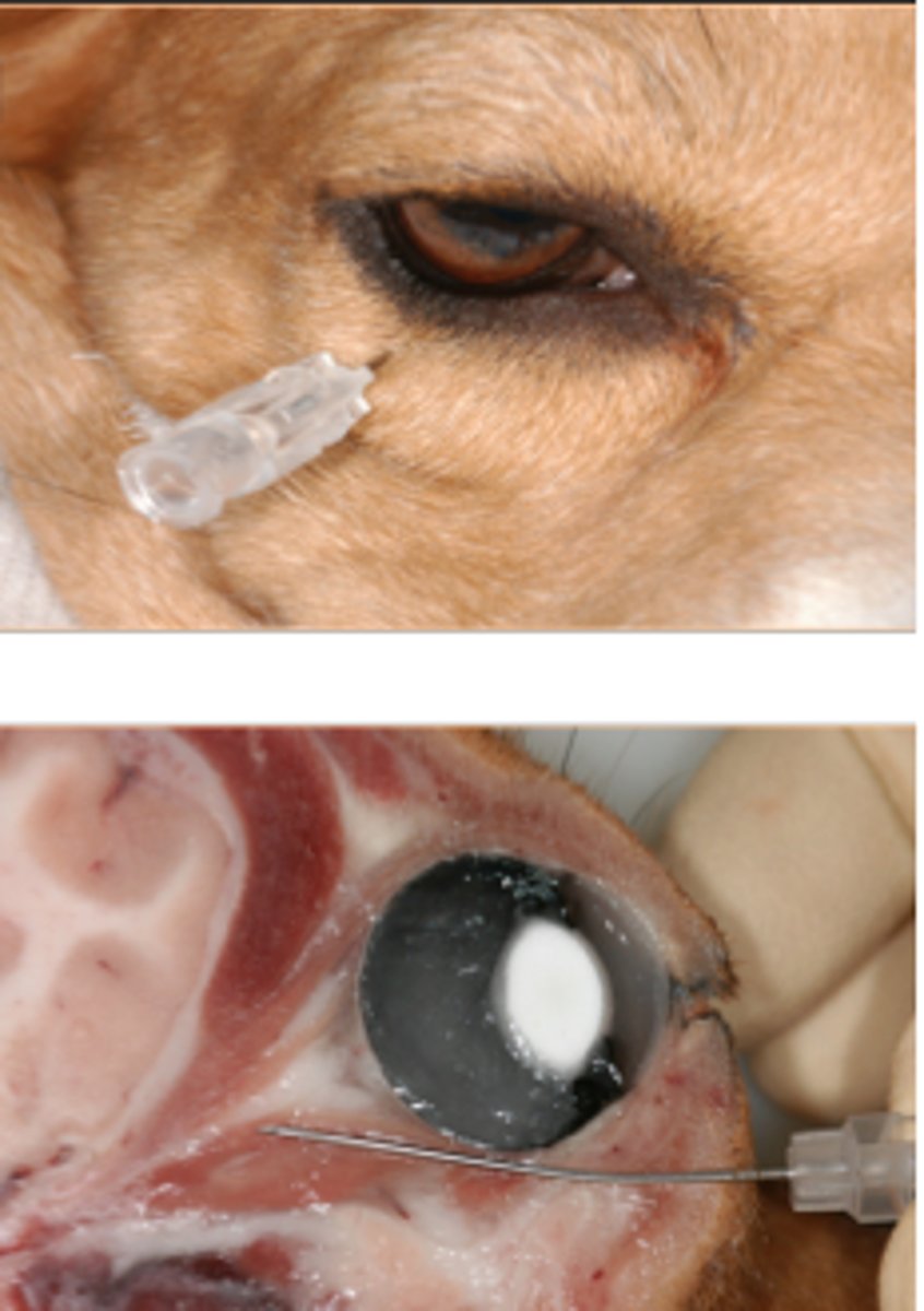 <ul><li><p>inner part of eye</p></li></ul><ul><li><p><span><span>Anaesthetises all the ciliary body nerves</span></span></p></li></ul><p></p>