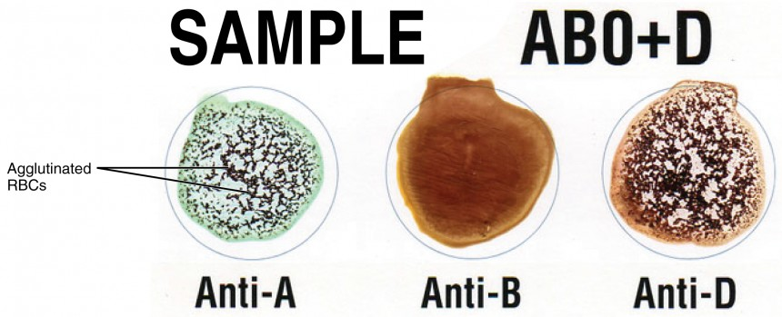 <p>-reactions used to determine blood type</p><p>-important consideration for transfusions</p><p>→mismatched blood can cause hemolytic transfusion reaction</p><p>→O- blood is universal ____</p><p>→AB+ blood is universal ___</p>