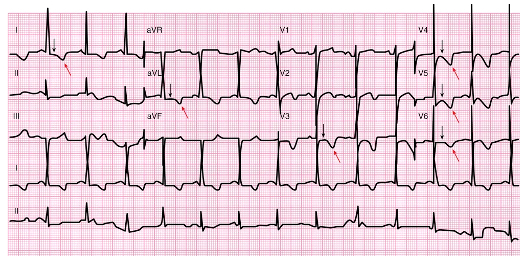 <p>Non-ST-Elevation MI (NSTEMI)</p><p>Caused by- ________________</p><ul><li><p>does NOT cause ST segment elevation</p></li><li><p>ECG may show ST depression &/or T wave inversion</p></li><li><p>Pts will usually undergo cardiac Catherization within ________</p></li><li><p>Thrombolytic therapy is ___________________</p></li></ul>