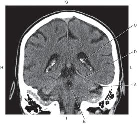 <p>Which line points to the tentorium cerebelli?</p>
