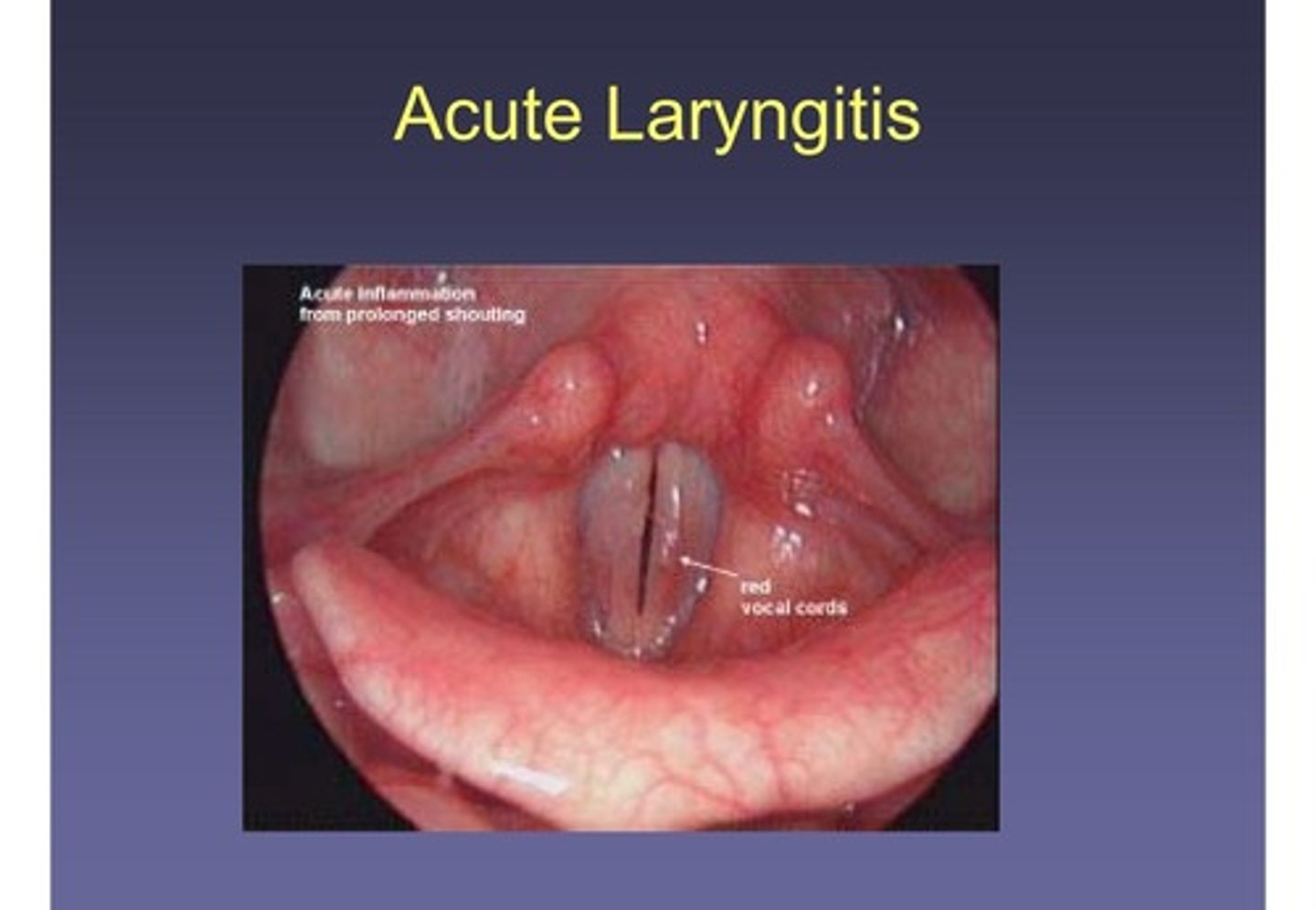 <p>Inflammation of the vocal folds due to various factors like vocal abuse or allergies.</p>