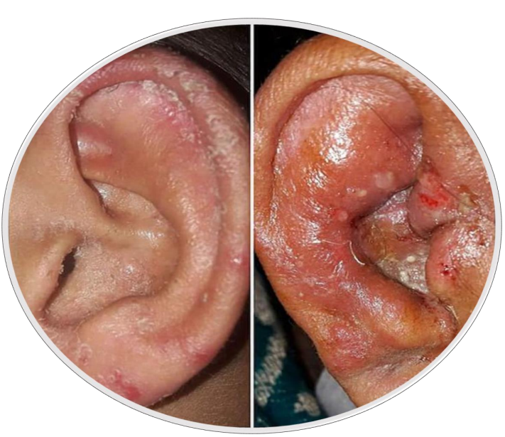 <p>What is this disorder</p>