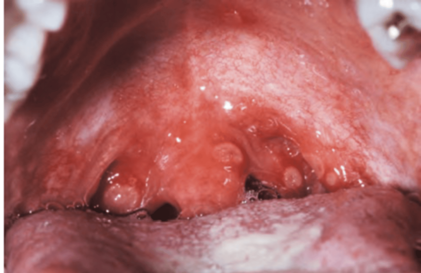 <p>Hint: Lesions typically develop on soft palate or tonsillar pillars</p>