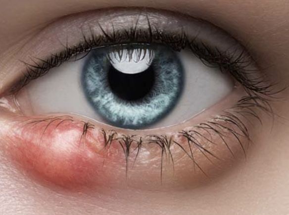 <p>Abnormal Findings for <strong><em>5. Redness, swelling, discharge, or lesions</em></strong></p><ul><li><p>Hair follicle infection, causes local redness, swelling, and pain</p></li></ul><p></p>