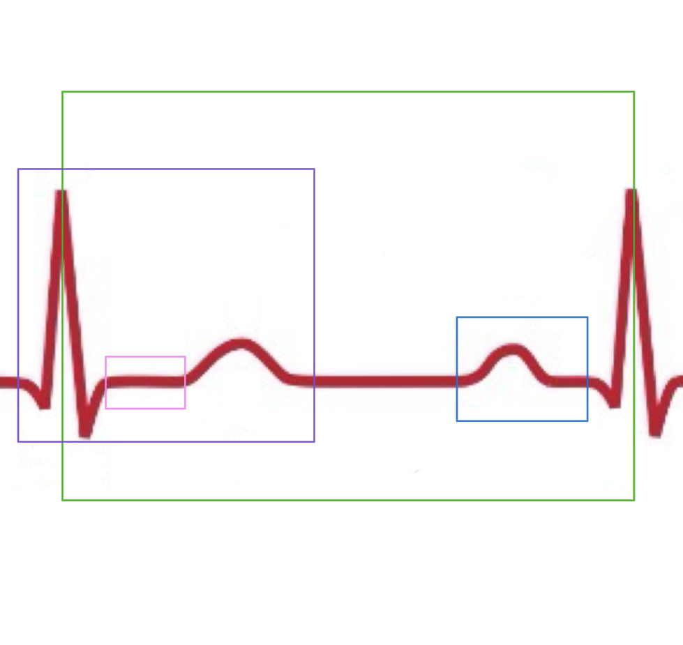 <p>What is electrically happening in the blue box of the EKG graph?</p>