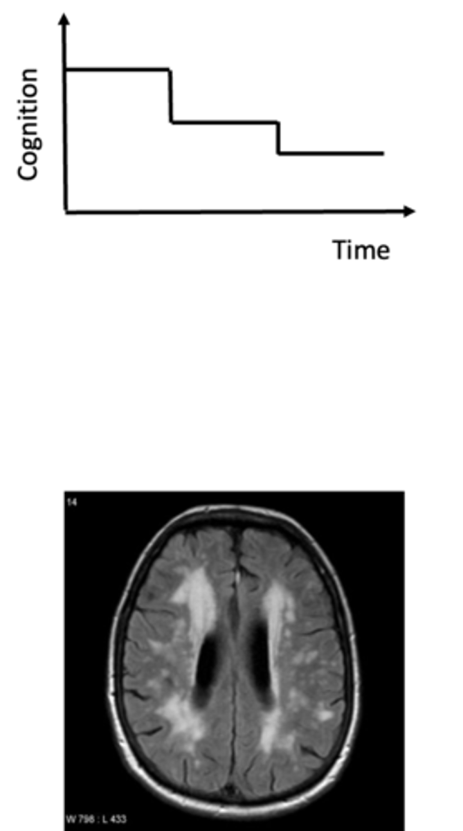 <p>- Onset is typically abrupt and deteriorates in a step-wise progression</p><p>- Typically slowness of thought, personality change, frontal-executive features</p><p>- History typically includes vascular risk factors and CT scan shows evidence of vascular lesions</p>