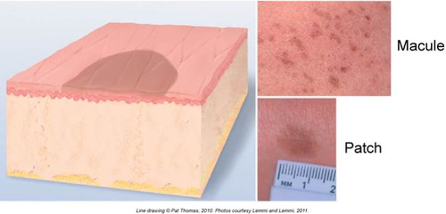 <p>Macule (primary lesion)</p>