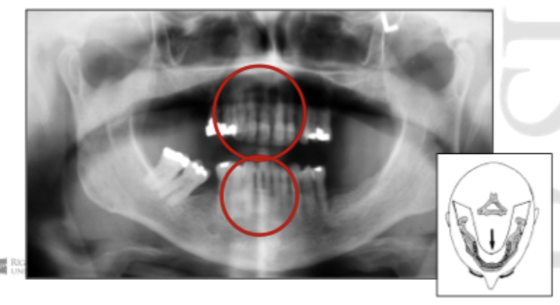 <p>Patient position - Antero-posterior error</p>