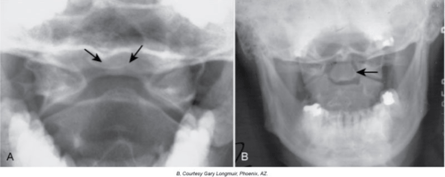 <p>How does Os Odontoideum occur?</p>