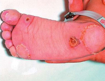<ul><li><p>Painful palmar and plantar hyperkeratotic lesions</p></li><li><p>Cognitive impairment</p></li></ul><p></p>