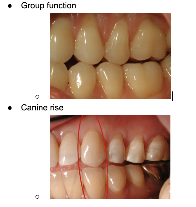 <p>Group function - multiple posterior teeth sharing the load during lateral movements, can lead to wear and TMJ stress</p><p>Canine rise - only the canines contact during lateral movements</p>