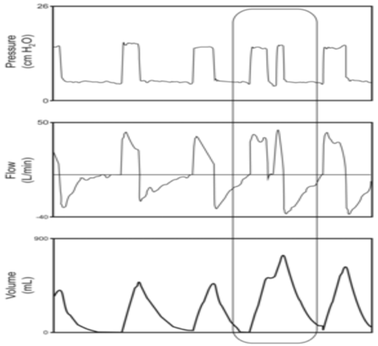 <p>Volume-time curve: Successive breaths increase lung volume without full exhalation.</p><p>Fix: Increase expiratory time, reduce respiratory rate, check trigger sensitivity to avoid auto-triggering.</p>