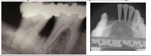 <p><span style="background-color: transparent; font-family: "Times New Roman", serif;">*<strong>Older children & Young adults</strong></span></p><p><span style="background-color: transparent; font-family: "Times New Roman", serif;">*Some cases of spontaneous regression</span></p><p><span style="background-color: transparent; font-family: "Times New Roman", serif;">*<strong>Solitary or multiple lesions in bone</strong> </span></p><p><span style="background-color: transparent; font-family: "Times New Roman", serif;"> - <strong>skull & mandible most common sites</strong></span></p><p><span style="background-color: transparent; font-family: "Times New Roman", serif;"><strong>*Radiograph: irregular radiolucent areas</strong></span></p><p><span style="background-color: transparent; font-family: "Times New Roman", serif;"><strong> - can mimic periodontal disease or</strong> <strong>periapical cysts/granulomas</strong></span></p><p><span style="background-color: transparent; font-family: "Times New Roman", serif;">*Some cases with skin involvement but NO visceral involvement</span></p><p><span style="background-color: transparent; font-family: "Times New Roman", serif;">*Looks like periodontal disease but unresponsive to scaling</span></p>