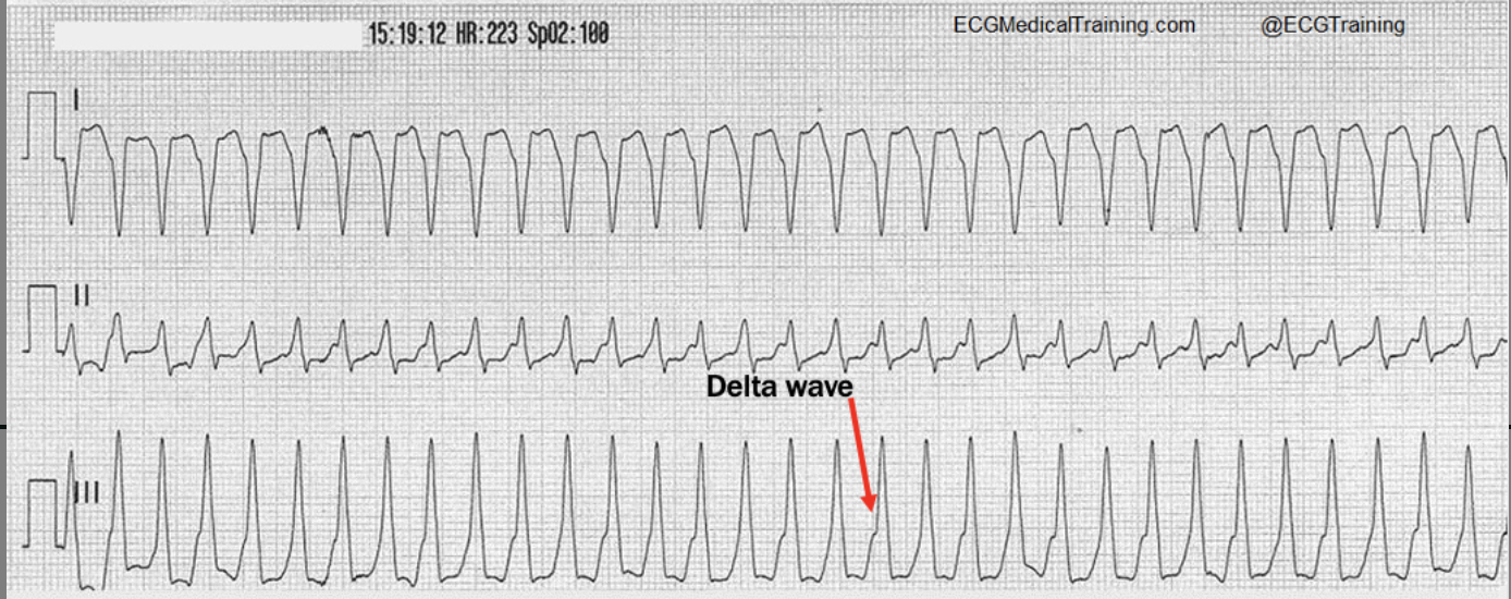 <p>wide QRS, no P waves</p>