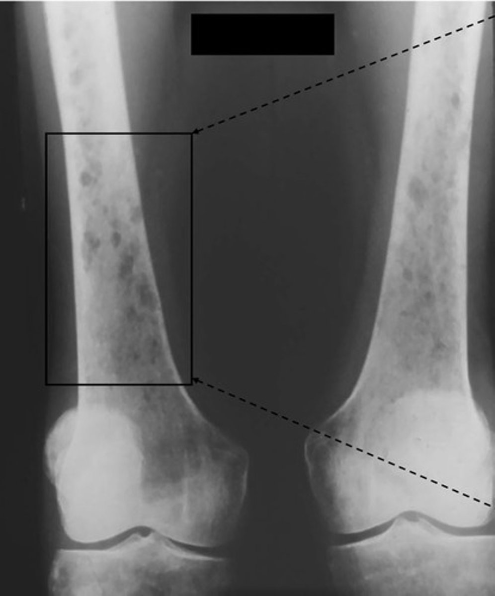 <p>Spiculated, elevated periosteum, bone destruction (think bad, very bad things)</p>