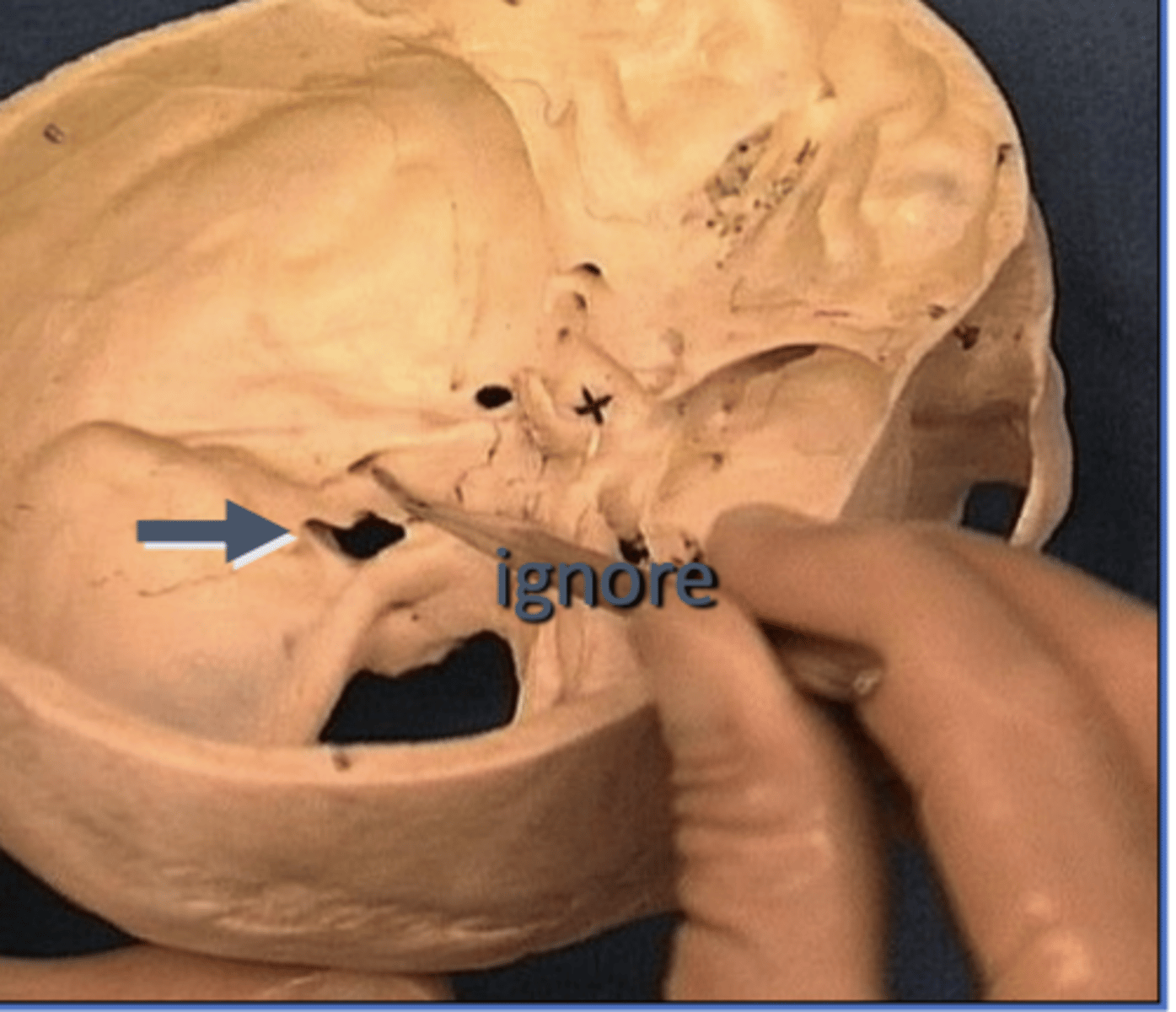<p>formed by the junction of the temporal and occipital bone</p>