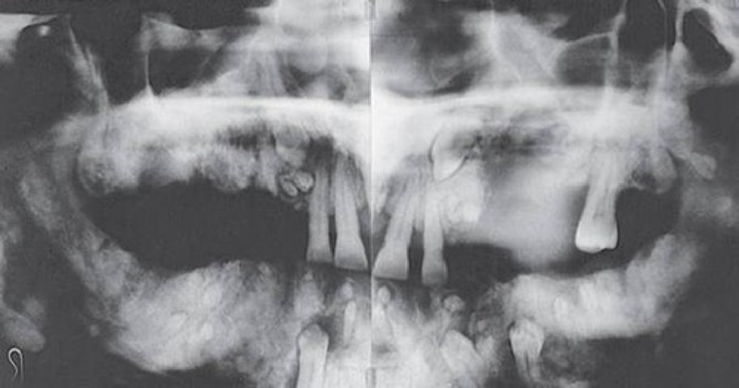 <p>-panoramic radiograph of patient with gardner syndrome shows multiple osteomas and odontomas</p><p>-also known as familial adenomatous polyposis</p><p>-benign bone growths</p><p>-teeth can exhibit hypercementosis and fail to erupt</p>