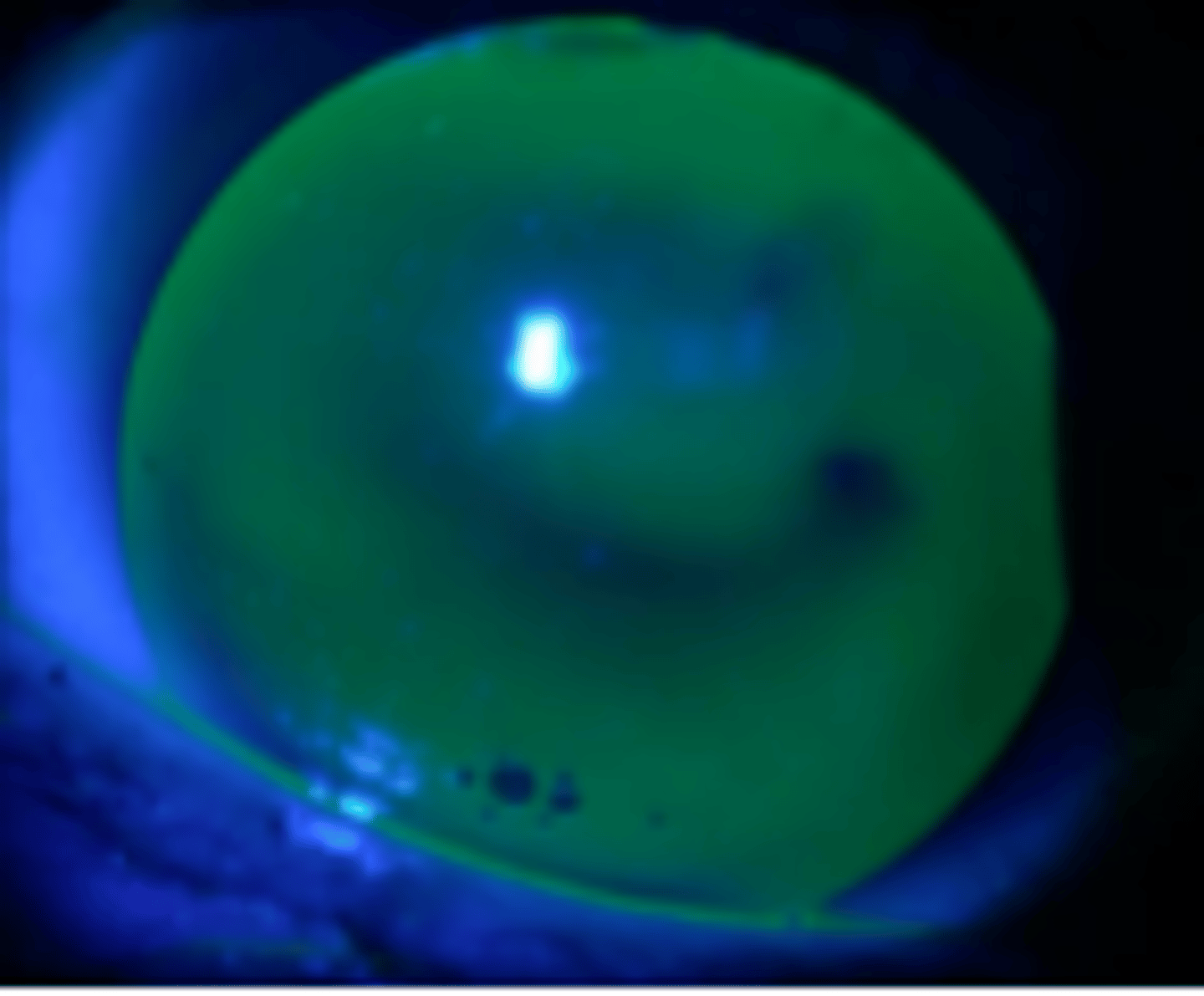 <p>GPCL lid interaction where the lens drops inferiorly between blinks, a variant of an interpalpebral fit. Is the least comfortable and desirable lid interaction to occur. May be indicated in prism ballasted lenses or irregular corneas.</p>