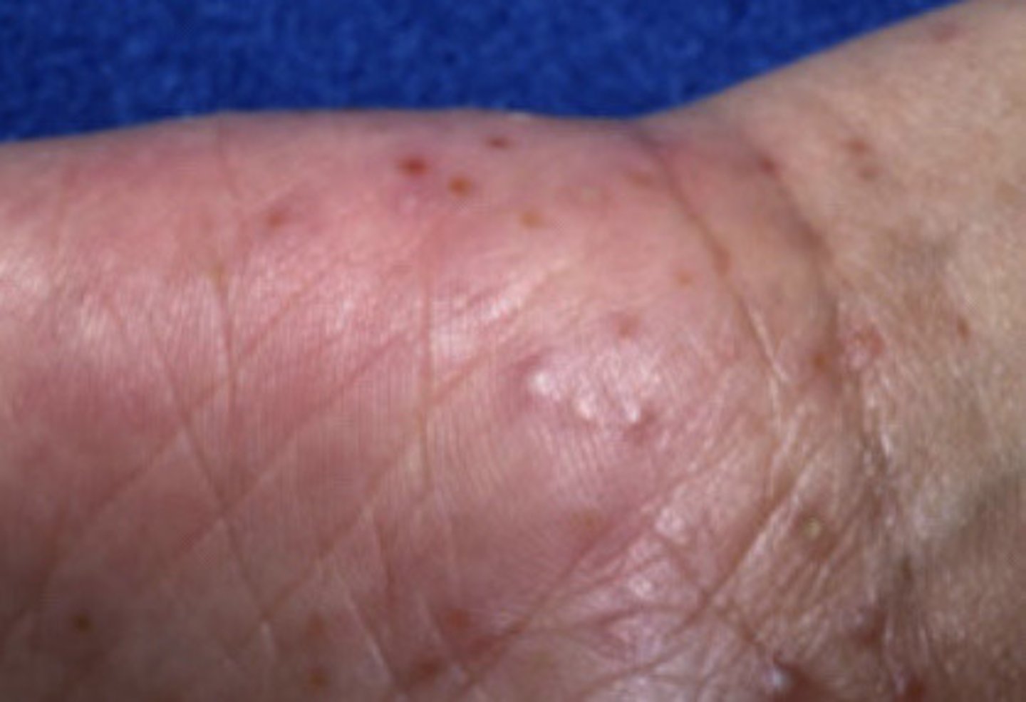 <p>1) Protective barrier (stop itching)<br>2) Antihistamine(Benadryl,Zyrtec, hydrazine)<br>3) avoid triggers<br>4) Topical Corticosteroids, glucorticoids, hydrocortisone</p>