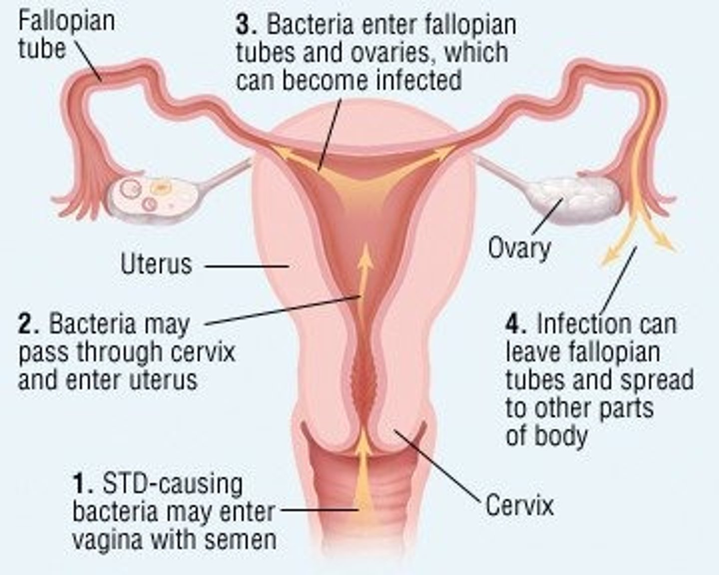<p>-microorganisms enter pelvic structures through the cervix from the vagina</p><p>-the causes usually is bacterial with gonoccoi and Chlamydia trachomatis being the most common pathogens</p><p>-infection travels up the uterus to the fallopian tubes and ovaries and can result in a pelvic abscess</p><p>-can cause peritonitis as pus from the infected tubes leaks into the abdomen</p>