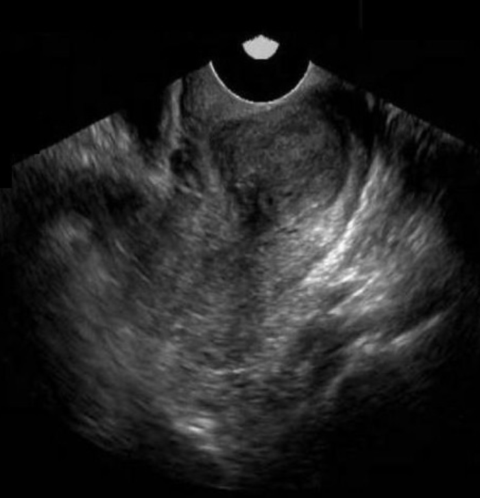 <p>30 yo has pelvic pressure + dyspareunia. she has <strong>partial hysterectomy</strong> 1 year ago.</p><p>a) large chronic hematoma remaining in the cervix</p><p>b) solid mass in cervix, most likely carcinoma</p><p>c) large complicated nabothian cyst</p><p>d) fibroid formation in the remaining uterine tissue left behind unintentionally</p>