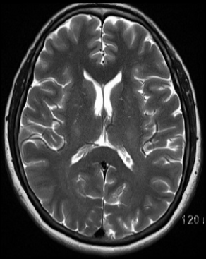 <p>Welche Strukturen sind auf dem T2-Bild hell bzw. dunkel?</p>