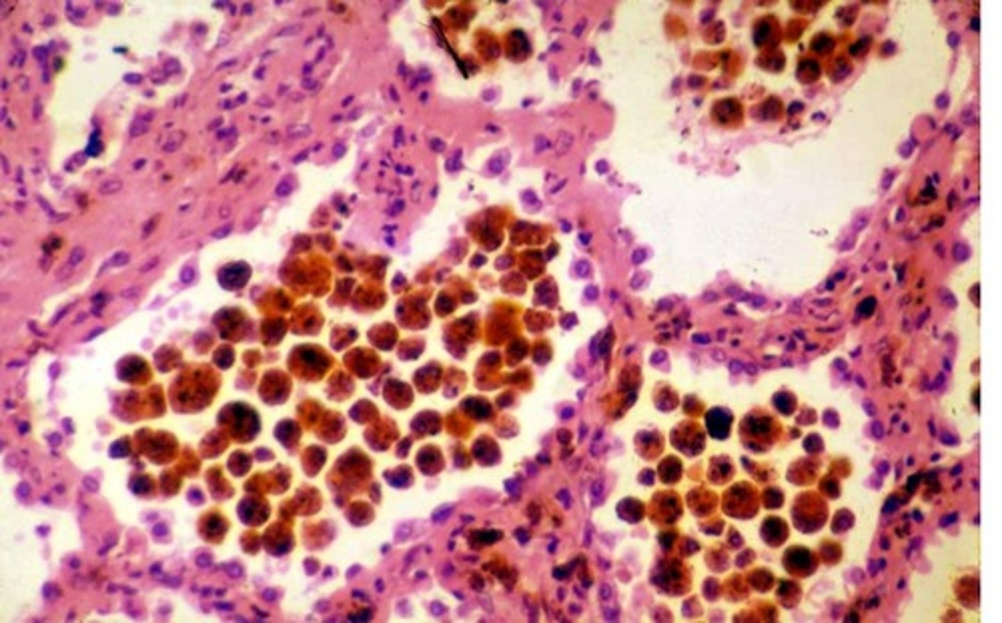 <p>Iron pigment from breakdown of blood or ingestion of iron </p><p>Golden brown pigment seen in macrophages</p><p>Bruising</p>
