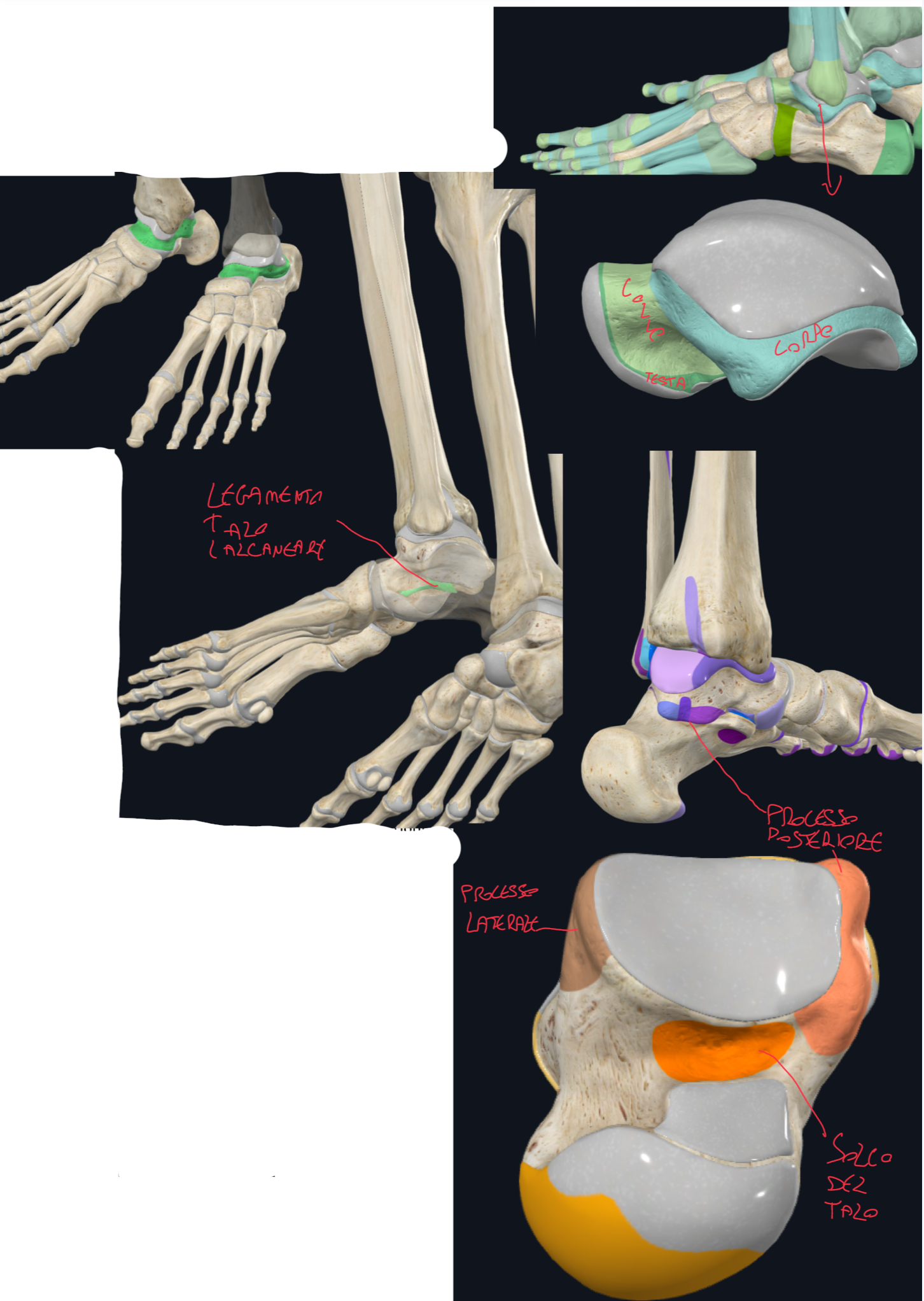 <p>TALO:</p><ul><li><p>Testa → con superficie articolare convessa per l’osso navicolare</p></li><li><p>Collo → sulla superficie superiore si attaccano legamenti, su quella inferiore abbiamo il solco del talo, che insieme a quello del calcagno formano il Seno del Tarso che accoglie il Legamento Talocalcaneale</p></li><li><p>Corpo → forma cubica, con processo laterale e posteriore. Superficie superiore per le ossa della gamba</p><ul><li><p>Il processo posteriore presenta il tubercolo mediale e laterale separato dal solco per il tendine del muscolo flessore lungo dell’alluce</p></li></ul></li></ul><p>Clinica:</p><ul><li><p>Il processo posteriore del talo è chiamato anche malleolo posteriore ed è clinicamente importante per la sua frattura nel corso di movimenti eccessivi</p></li></ul><p>N.B. nessun muscolo si inserisce sul talo, si inseriscono piuttosto legamenti della caviglia e calcagno.</p><p></p>