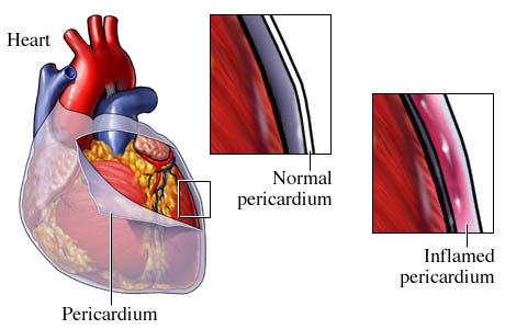 inflammation of the pericardium 
- typically an infection of the heart
- layers can adhere to one another
- interferes with the heart contractions