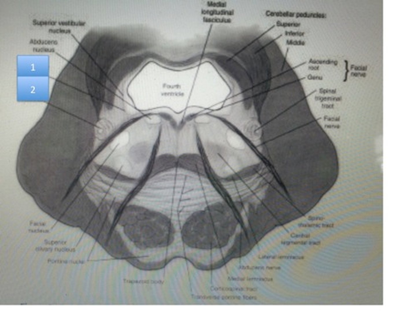 <p>white spots above 4th ventricle</p>