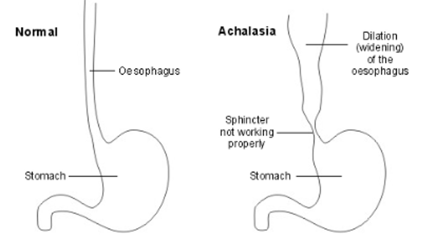 <p>esophagus doesn't relax properly in response to swallowing</p>