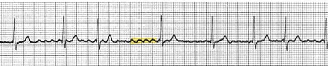 <p>Trigger site at junction of pulmonary veins</p><p>Wavelets of reentry cause chaotic electrical activity</p><p>The atria quiver instead of contracting</p><p>Because AV node is not in refractory, electrical impulses reach the AV node causing QRS complex</p>