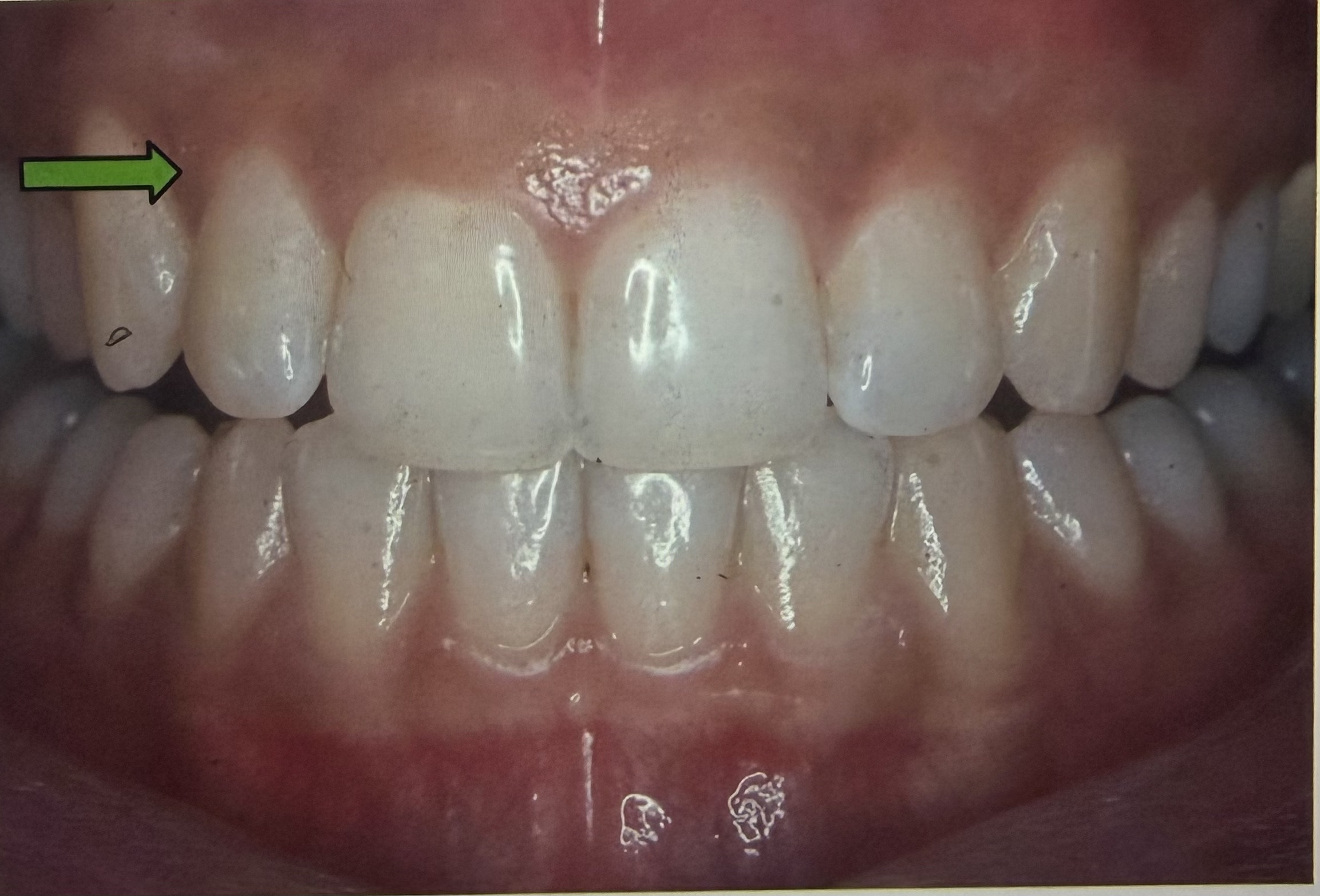 <p><span><span>Which part of the gingiva is the arrow pointing to?</span></span></p>