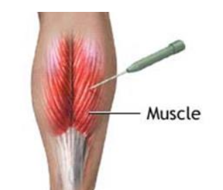 <p>Invasive electrodes used to record biovoltages from a small area of tissue<br>fx.: individual nerves and muscle fibers</p>