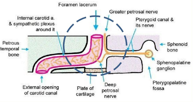 <p>shows the passage of the ICA near the petrosphenoidal fissure </p>