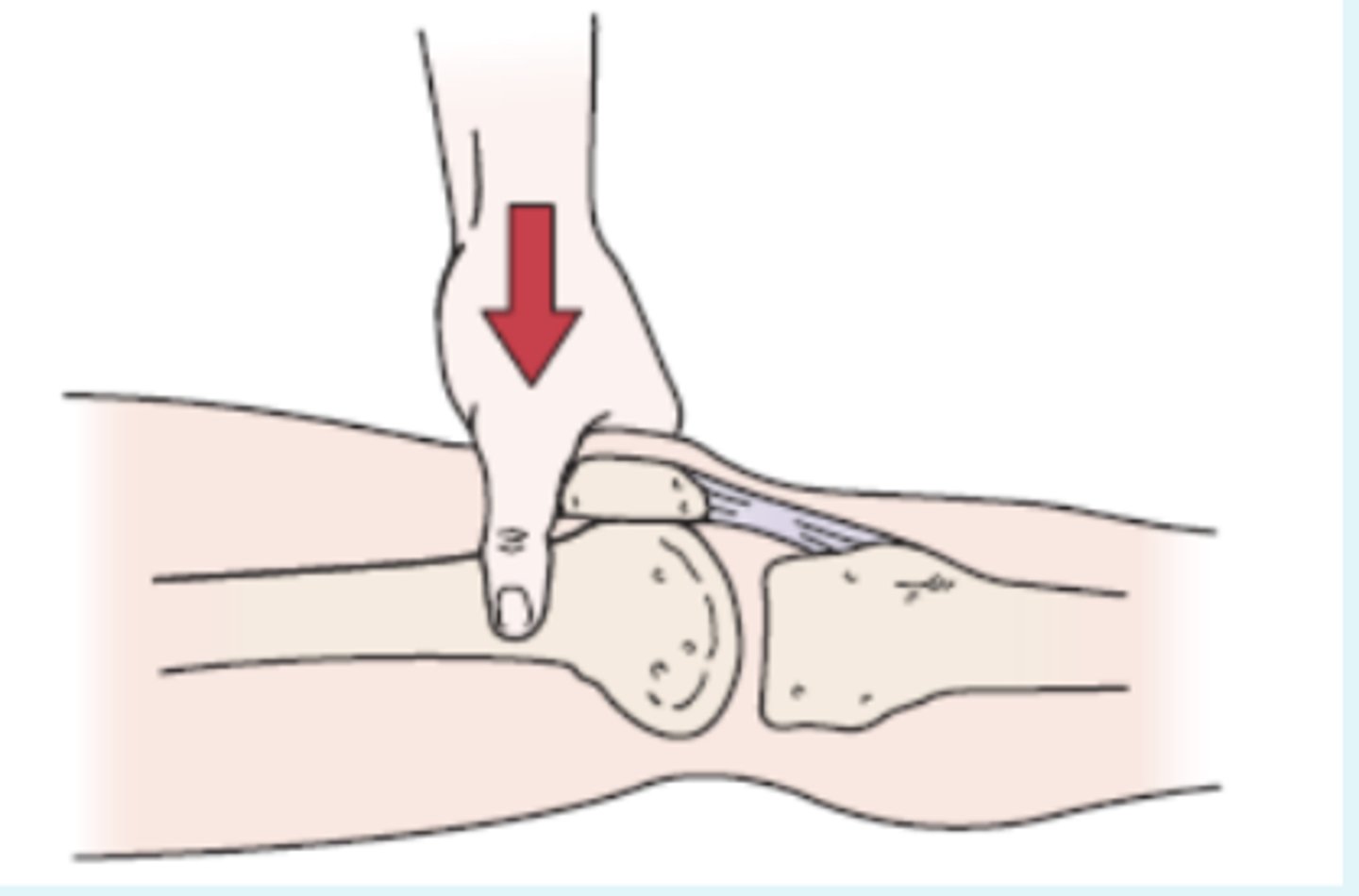 <p>- patellofemoral dysfunction</p><p>procedure:</p><p>- The examiner presses down slightly proximal to the base of the patella with the web of the hand as the patient lies relaxed with the knee extended. The patient is then asked to contract the quadriceps muscles while the examiner pushes down.</p><p>(+): If the patient can complete and maintain the contraction without pain, the test is considered negative. If the test causes retropatellar pain and the patient cannot hold a contraction, the test is considered positive.</p>