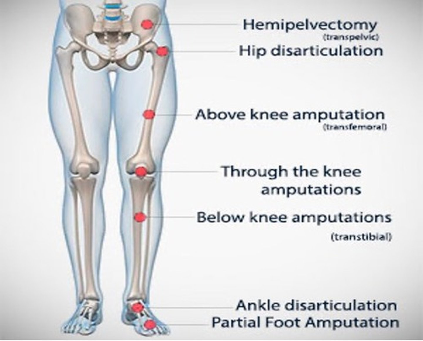 <p>-Hemipelvectomy<br>-Hip Disarticulation<br>-Above knee or transfemoral<br>-Knee Disarticulation<br>-Below knee or transtibial<br>-Syme's<br>-Partial Foot/transmetatarsal</p>