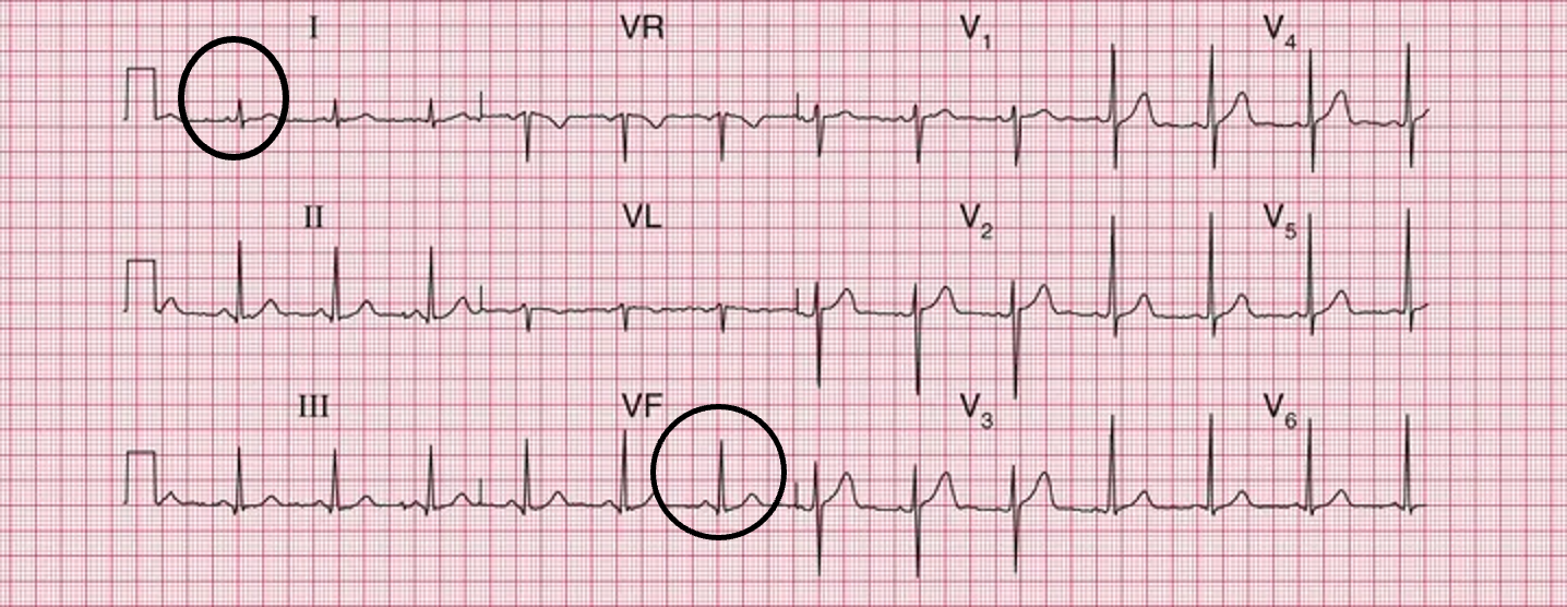 <p>both I and aVF mostly positively deflected</p>