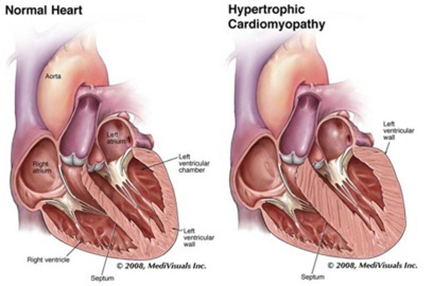 <p>heart muscle becomes enlarged and blocks blood flow</p>
