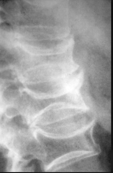 <p>what is seen here for this case of osteomalacia?</p>